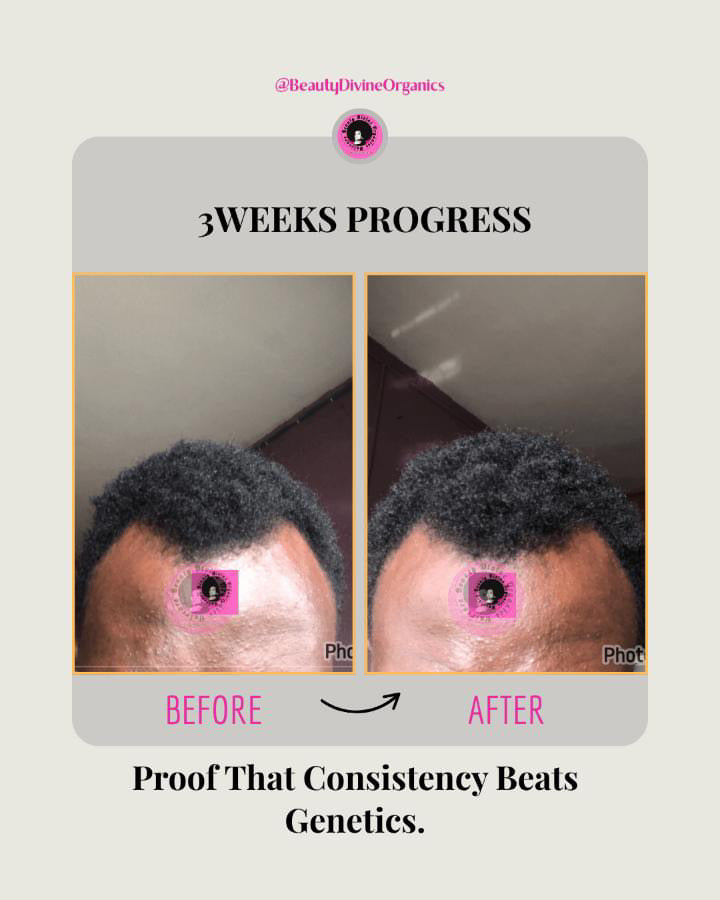 Anti-Hairloss & Receding Hairline Kit